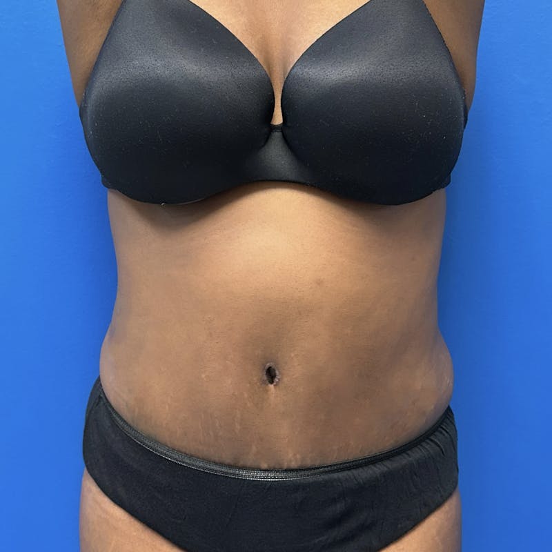 Abdominoplasty Before & After Gallery - Patient 164070 - Image 2