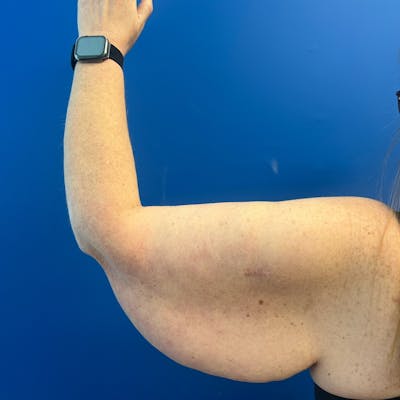 Arm Lift Before & After Gallery - Patient 780649 - Image 1