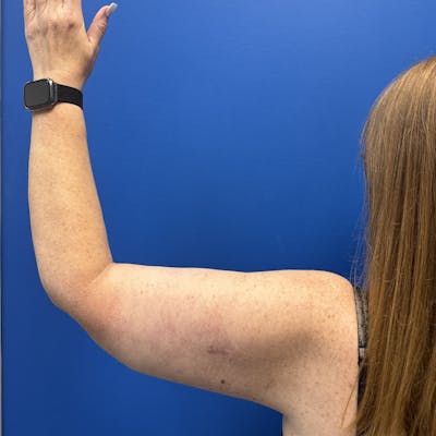 Arm Lift Before & After Gallery - Patient 780649 - Image 2
