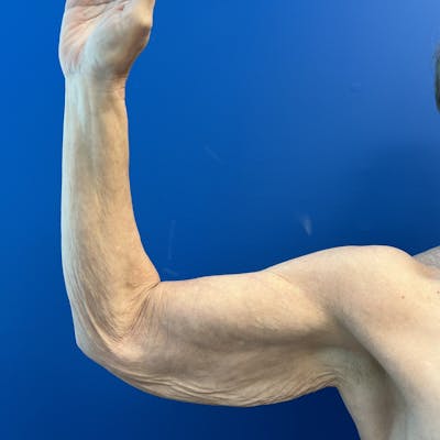 Arm Lift Before & After Gallery - Patient 404997 - Image 1