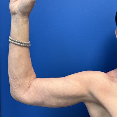 Arm Lift Before & After Gallery - Patient 404997 - Image 2