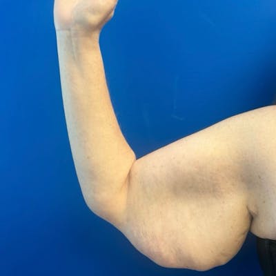 Arm Lift Before & After Gallery - Patient 257046 - Image 1