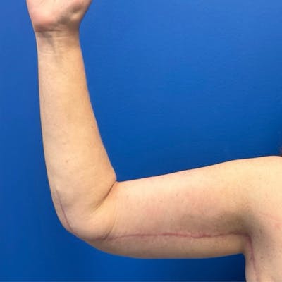 Arm Lift Before & After Gallery - Patient 257046 - Image 2