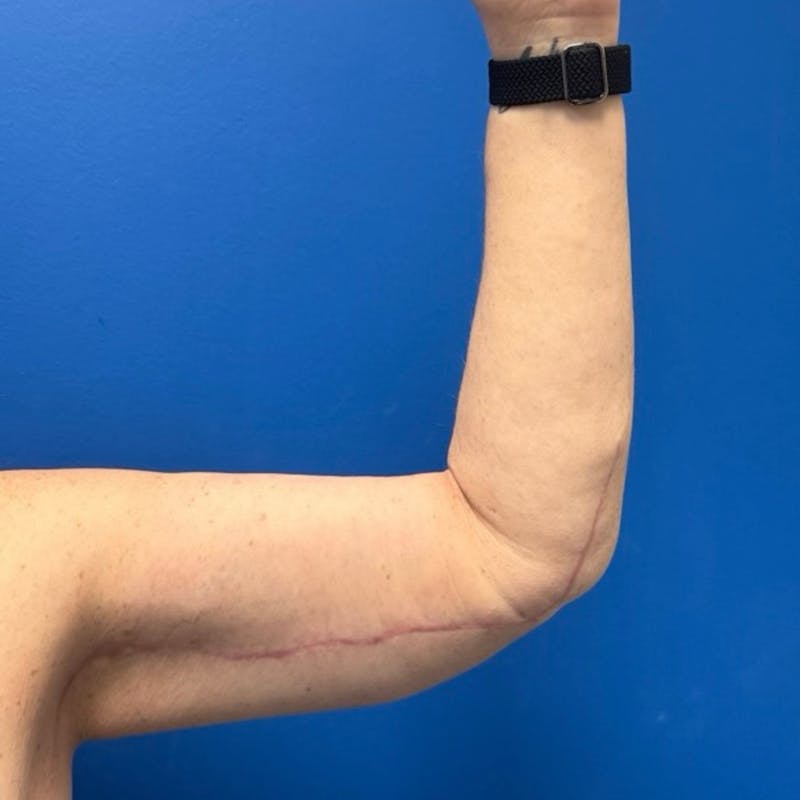 Arm Lift Before & After Gallery - Patient 257046 - Image 4