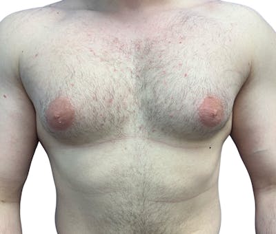 Male Breast Reduction Before & After Gallery - Patient 208756 - Image 1