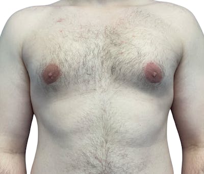 Male Breast Reduction Before & After Gallery - Patient 208756 - Image 2
