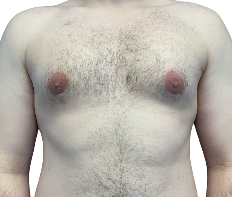 Male Breast Reduction Before & After Gallery - Patient 208756 - Image 2