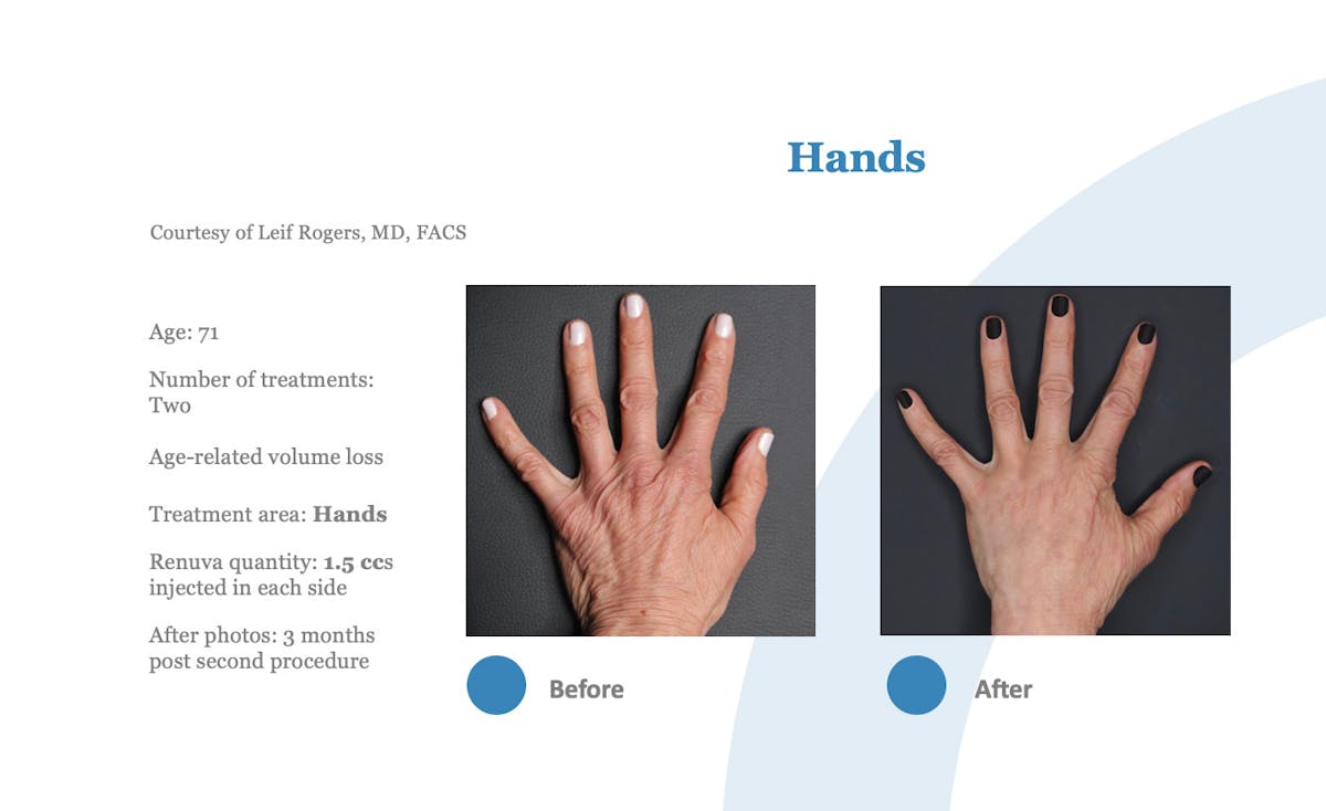 Renuva Before & After Gallery - Patient 164320 - Image 1