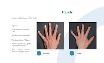 Renuva Before & After Gallery - Patient 164320 - Image 1