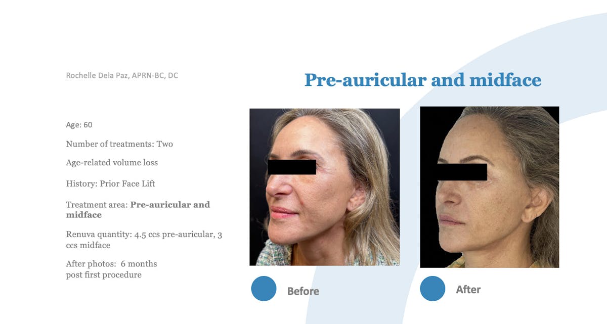 Renuva Before & After Gallery - Patient 518858 - Image 1