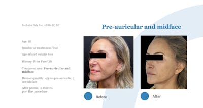 Renuva Before & After Gallery - Patient 518858 - Image 1