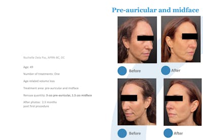 Renuva Before & After Gallery - Patient 207646 - Image 1