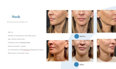 Renuva Before & After Gallery - Patient 329866 - Image 1