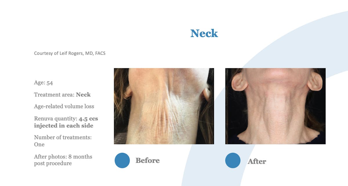 Renuva Before & After Gallery - Patient 358270 - Image 1