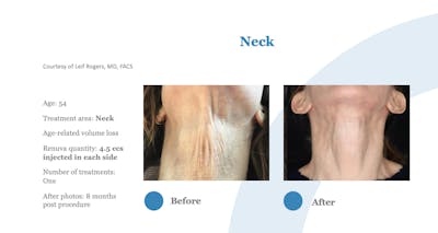 Renuva Before & After Gallery - Patient 358270 - Image 1