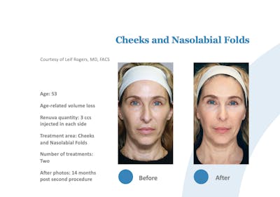 Renuva Before & After Gallery - Patient 392258 - Image 1