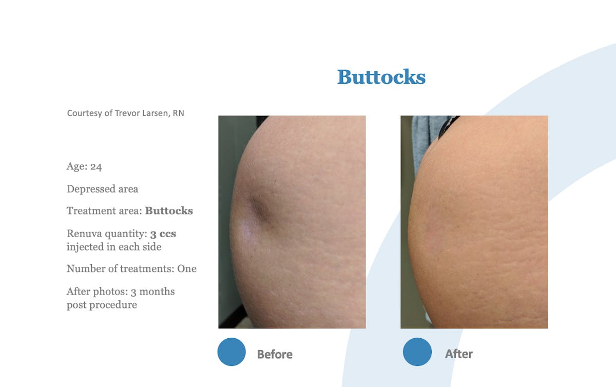Renuva Before & After Gallery - Patient 284835 - Image 1