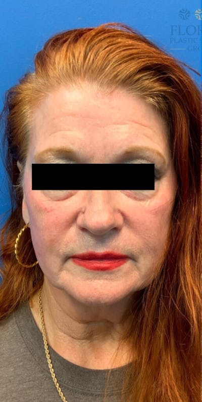 Injectables and Dermal Fillers Before & After Gallery - Patient 154949120 - Image 1