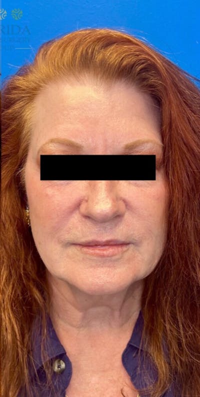 Injectables and Dermal Fillers Before & After Gallery - Patient 154949120 - Image 2