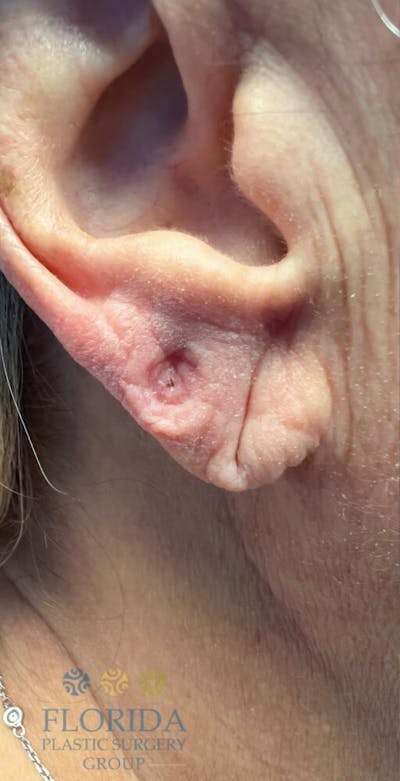 Injectables and Dermal Fillers Before & After Gallery - Patient 154949138 - Image 1