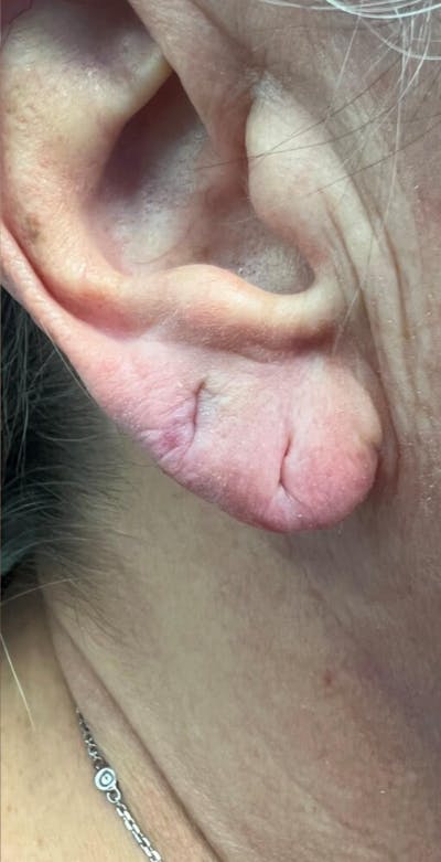 Injectables and Dermal Fillers Before & After Gallery - Patient 154949138 - Image 2
