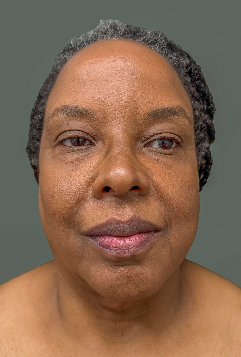 Deep Plane Face/Neck lift Before & After Gallery - Patient 380894 - Image 1