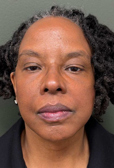 Deep Plane Face/Neck lift Before & After Gallery - Patient 380894 - Image 2