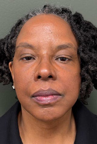 Deep Plane Face/Neck lift Before & After Gallery - Patient 380894 - Image 2