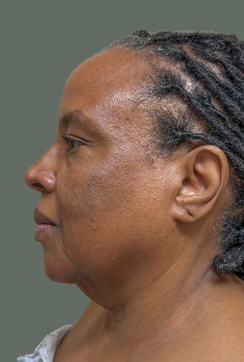 Deep Plane Face/Neck lift Before & After Gallery - Patient 380894 - Image 3