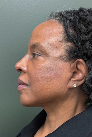 Deep Plane Face/Neck lift Before & After Gallery - Patient 380894 - Image 4