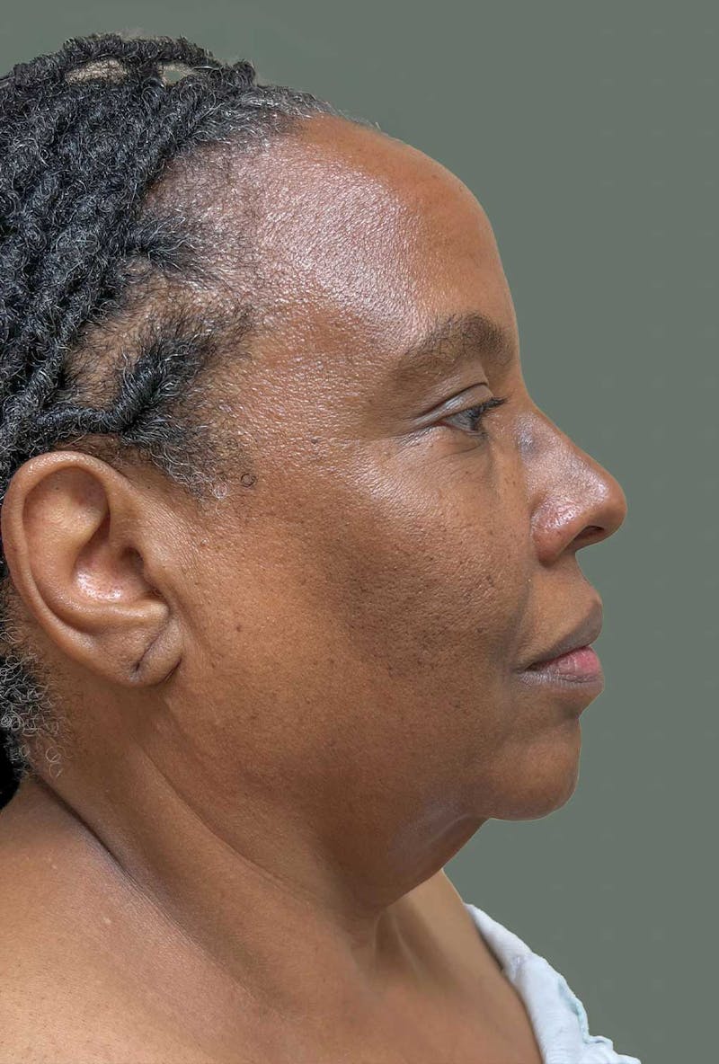 Deep Plane Face/Neck lift Before & After Gallery - Patient 380894 - Image 5