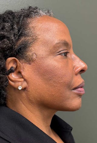 Deep Plane Face/Neck lift Before & After Gallery - Patient 380894 - Image 6