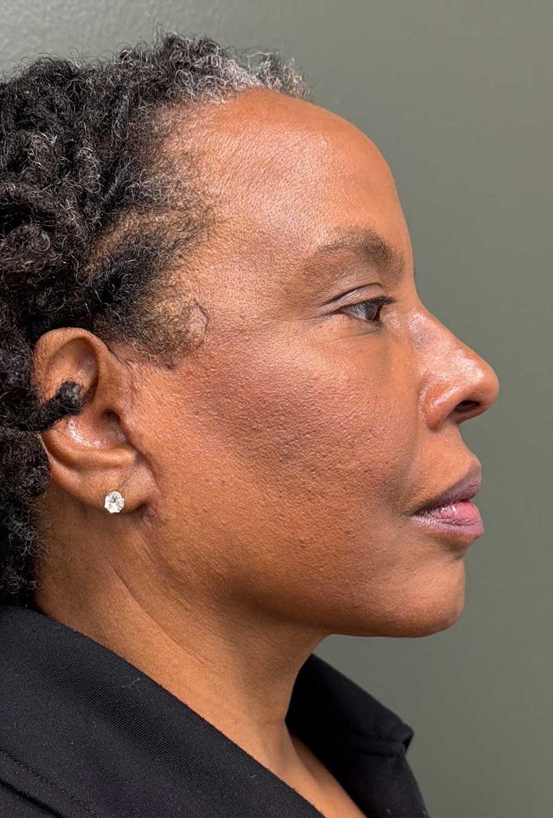 Deep Plane Face/Neck lift Before & After Gallery - Patient 380894 - Image 6
