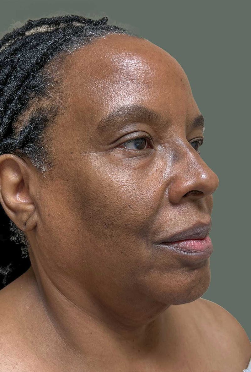 Deep Plane Face/Neck lift Before & After Gallery - Patient 380894 - Image 7
