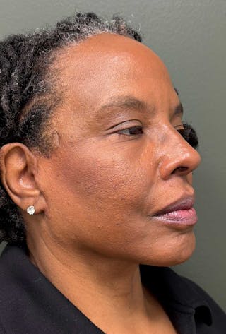Deep Plane Face/Neck lift Before & After Gallery - Patient 380894 - Image 8
