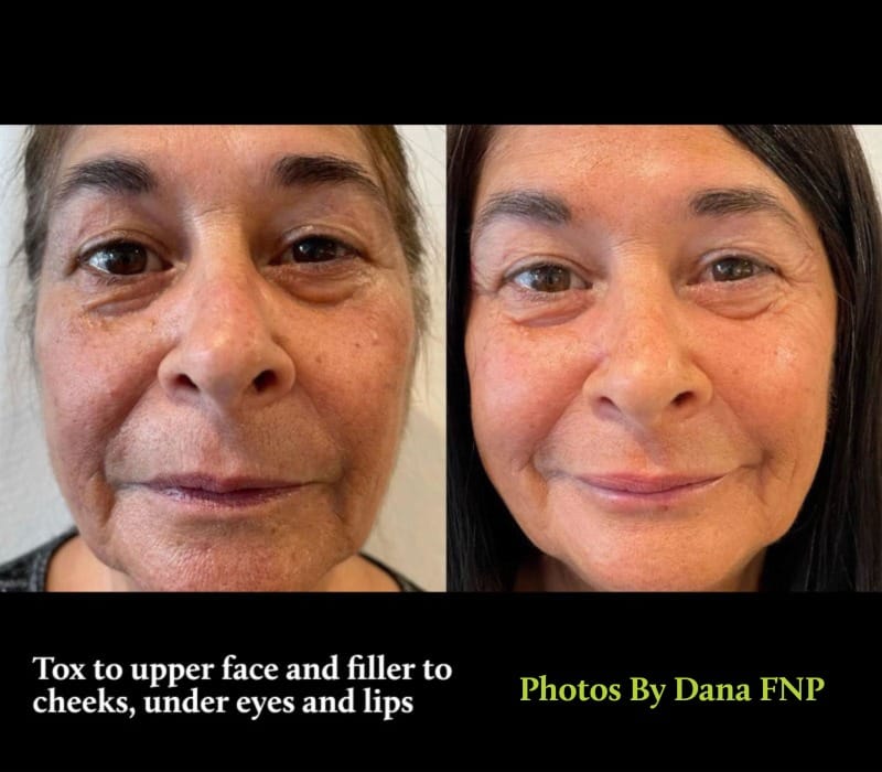 Before and after fillers