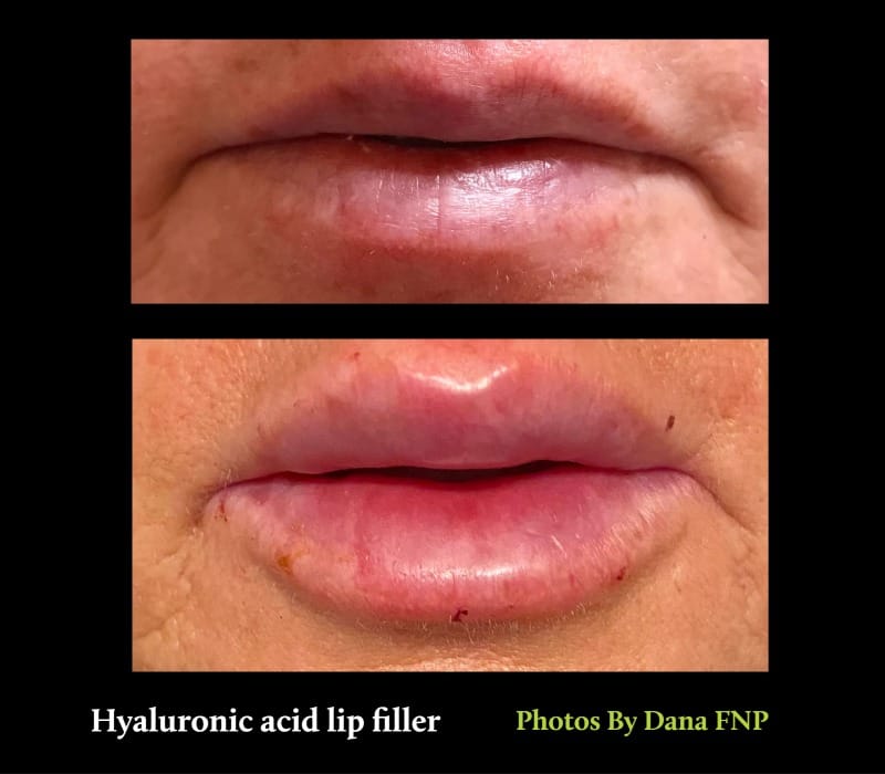 before and after botox