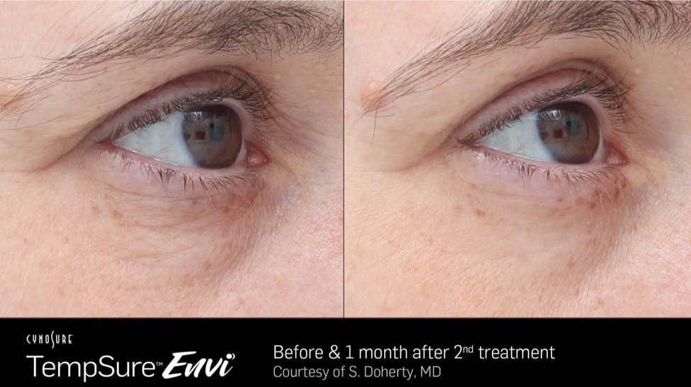 Before and After TempSure Envi