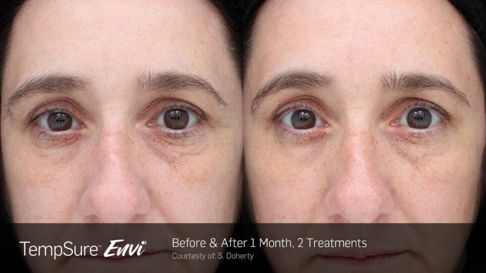 Before and After TempSure Envi