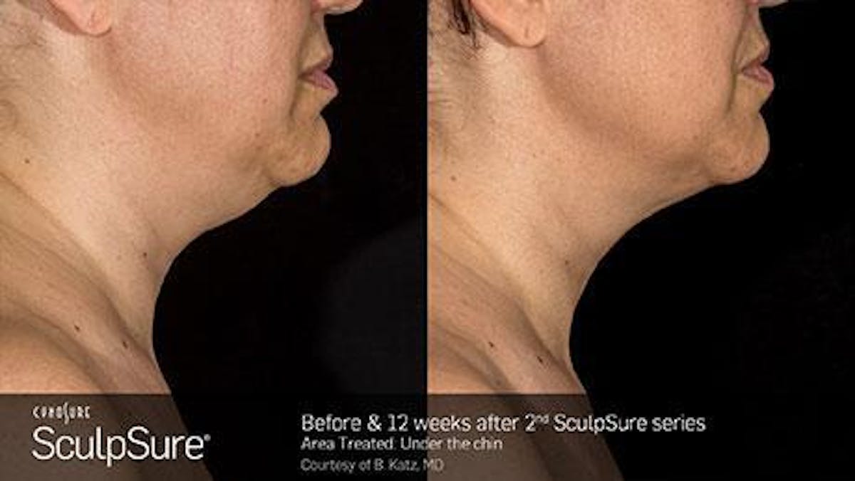 Sculpsure Submental Before & After Gallery - Patient 179749775 - Image 1