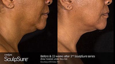 Sculpsure Submental Before & After Gallery - Patient 179749776 - Image 1