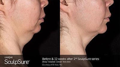 Sculpsure Submental Before & After Gallery - Patient 179749777 - Image 1