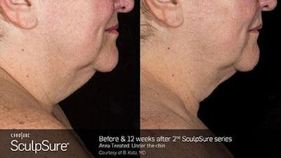 Sculpsure Submental Before & After Gallery - Patient 179749779 - Image 1