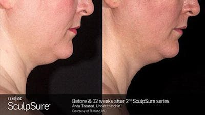 Sculpsure Submental Before & After Gallery - Patient 179749780 - Image 1