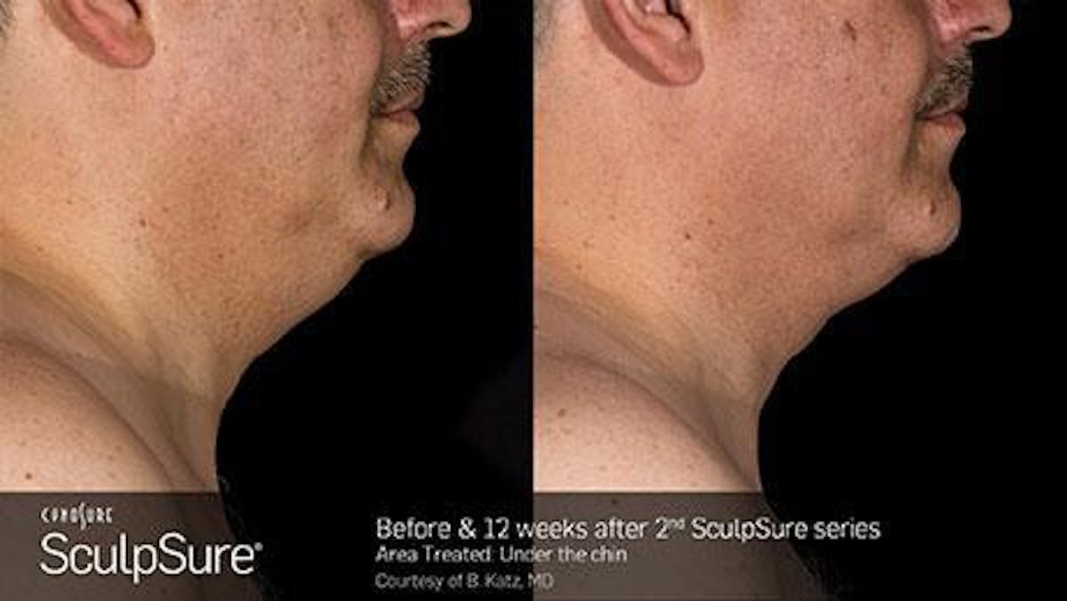 Sculpsure Submental Before & After Gallery - Patient 179749781 - Image 1