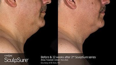 Sculpsure Submental Before & After Gallery - Patient 179749781 - Image 1