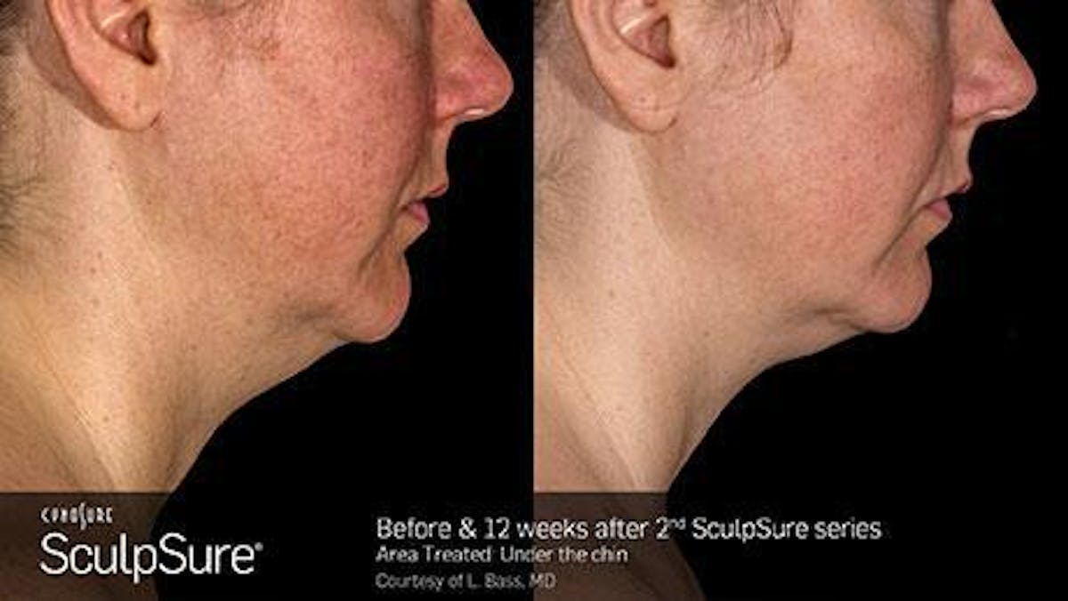 Sculpsure Submental Before & After Gallery - Patient 179749782 - Image 1