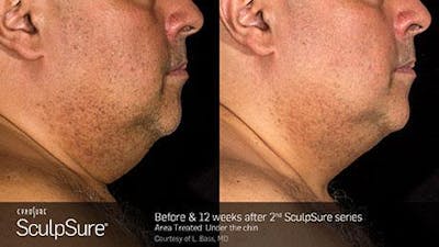Sculpsure Submental Before & After Gallery - Patient 179749783 - Image 1