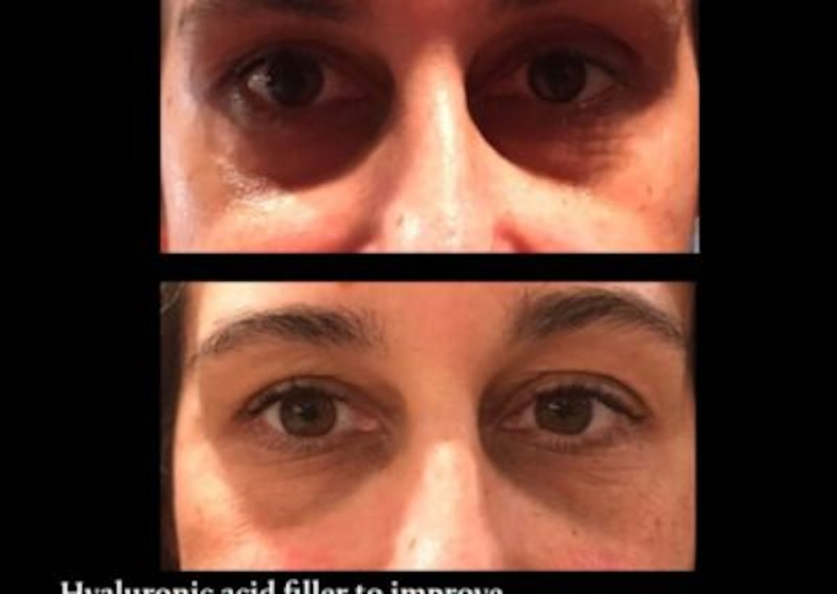 Tox and Fillers Before & After Gallery - Patient 179749810 - Image 1