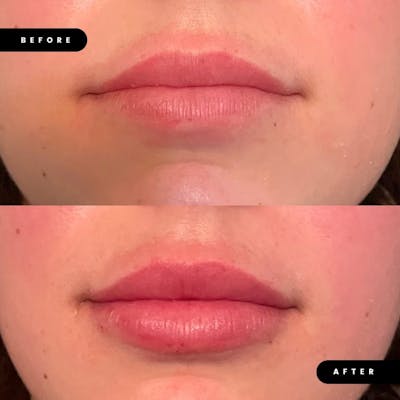 Lip Fillers Before & After Gallery - Patient 180396739 - Image 1